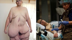 元世界一太った男性　胃のバンド手術で痩せたものの、垂れた皮膚だけで21キロ