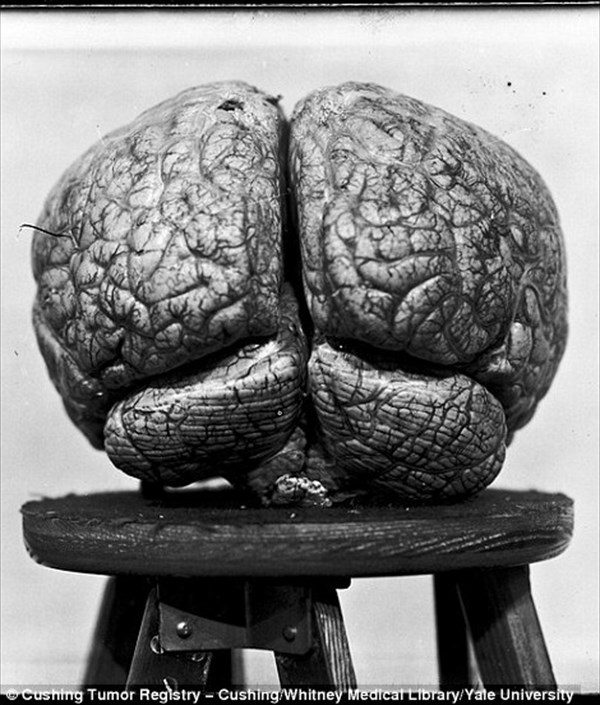大学の地下室で発見された、およそ100年前の初期の脳手術患者の写真