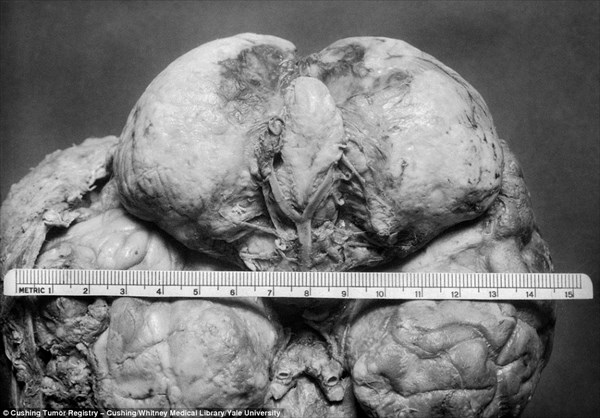 大学の地下室で発見された、およそ100年前の初期の脳手術患者の写真