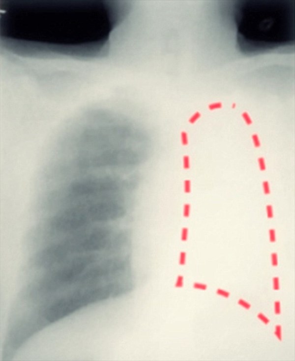 レントゲン写真で左肺が無かった男　原因は20年前に吸い込んだペンのキャップ