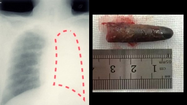 レントゲン写真で左肺が無かった男　原因は20年前に吸い込んだペンのキャップ