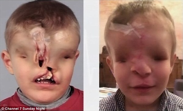 生まれつき目・鼻・上あごを持たずに生まれた男の子　再建手術で新たな顔を得る