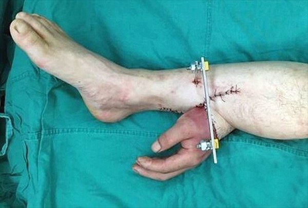 事故で右手を切断してしまった男性　一時的に足に移植し一ヶ月後に腕に再接合！