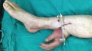 事故で右手を切断してしまった男性　一時的に足に移植し一ヶ月後に腕に再接合！