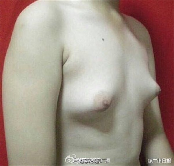 中国人男性フライドチキンの食べ過ぎで胸が女体化！？　成長ホルモン剤が原因か