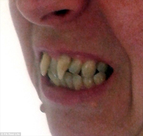 歯周病で歯がヴァンパイアの牙のようになった女性　歯科医を訴え480万獲得