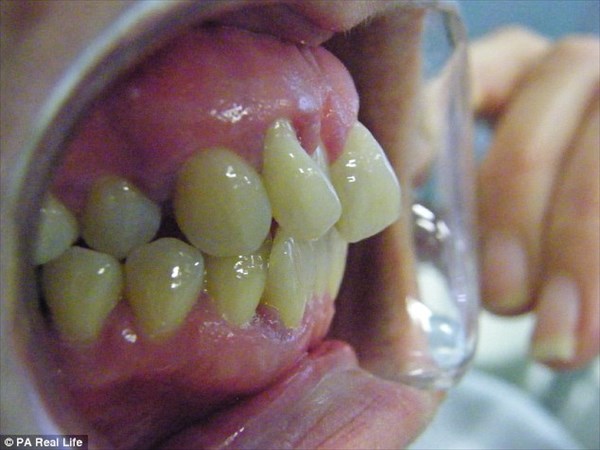 歯周病で歯がヴァンパイアの牙のようになった女性　歯科医を訴え480万獲得