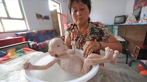 肛門を持たずに生まれた赤ちゃん　生後三か月で体重2.4キロ　家族が支援要求