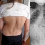 背骨グニャリ　重度の脊椎側弯症の女性　10年にわたる治療で回復！