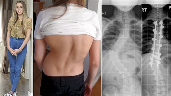 背骨グニャリ　重度の脊椎側弯症の女性　10年にわたる治療で回復！