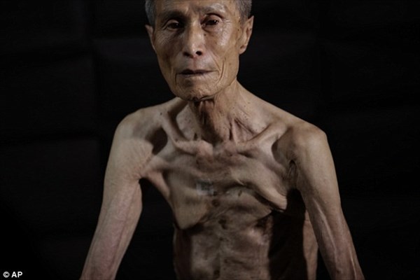 今日で長崎原爆から70年　爆心地から1.8キロで被ばくした谷口稜曄さん