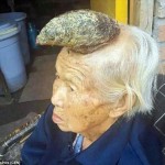 中国・四川省の高齢女性の頭部に長さ13センチの角が生える！　ガンの可能性も