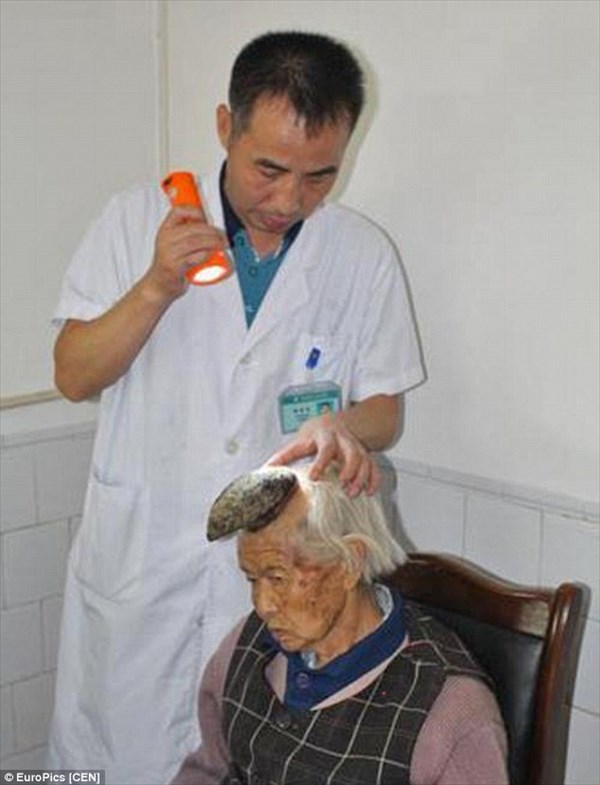 中国・四川省の高齢女性の頭部に長さ13センチの角が生える！　ガンの可能性も