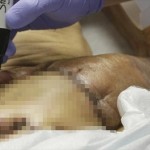 車に潰された手を損傷＆火傷した87歳男性　一時的に手を腹部に移植し回復へ！