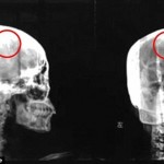 長年の頭痛の正体は、脳に突き刺さっていた4.5センチの針！　46年間も脳に