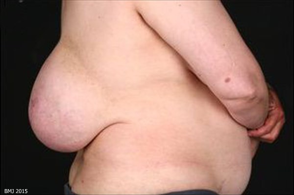 背中におっぱいを持っていた女性　その正体は脂肪腫！！