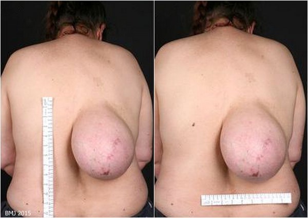 背中におっぱいを持っていた女性　その正体は脂肪腫！！