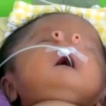 パトウ症候群という遺伝子疾患によってチューブ状の鼻を持って誕生した赤ちゃん