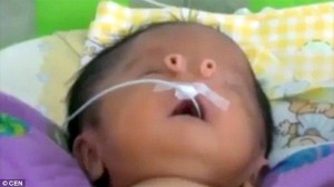 パトウ症候群という遺伝子疾患によってチューブ状の鼻を持って誕生した赤ちゃん