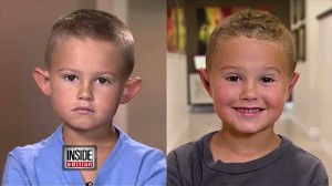 「エルフの耳」とからかわれイジメられた6歳の男の子　整形手術をする！
