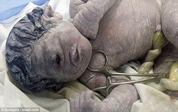 エジプトで単眼症による一つ目の赤ちゃん誕生　妊娠中の放射能被ばくが原因か