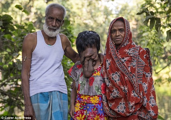 神経線維腫症によって顔が皮膚に覆われたインドの女性　地元関係者が募金を募る