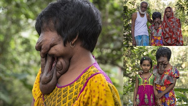 神経線維腫症によって顔が皮膚に覆われたインドの女性　地元関係者が募金を募る