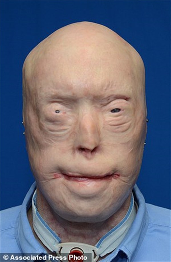 火事で顔を失った消防士　顔面移植により14年ぶりに新しい顔を得る！