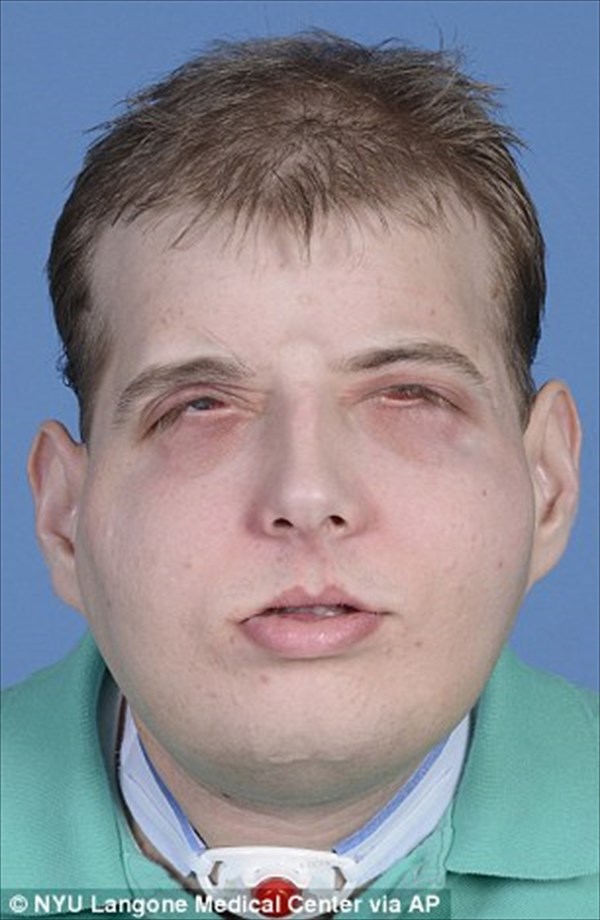 火事で顔を失った消防士　顔面移植により14年ぶりに新しい顔を得る！