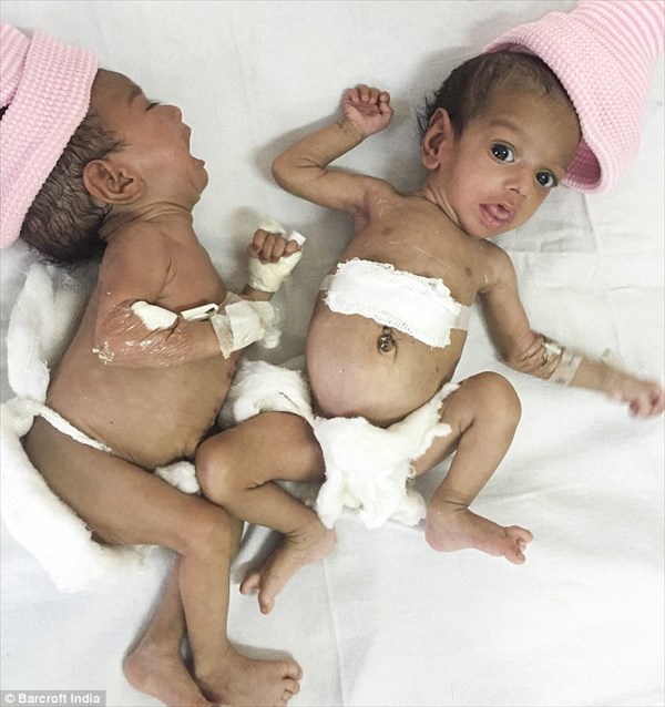 結合双生児(シャム双生児)のジャナットとマナット、無事に分離手術成功！