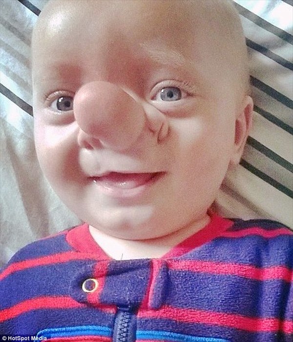ピノキオを呼ばれる男の子　大きな鼻の原因は頭蓋骨の隙間による脳ヘルニア