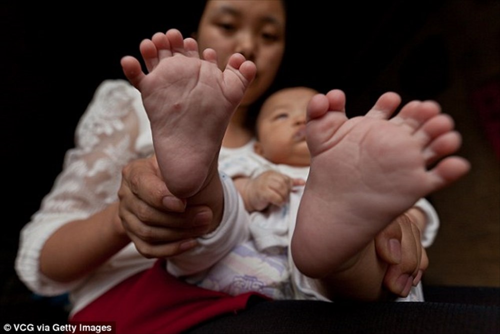  【母も多指症】15本の指と16本の足の指を持つ中国の赤ちゃん、除去手術へ