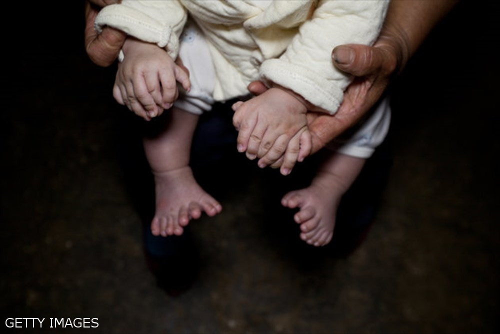  【母も多指症】15本の指と16本の足の指を持つ中国の赤ちゃん、除去手術へ
