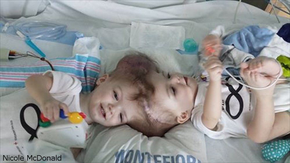 脳がつながった状態で生まれた結合双生児、20時間に渡る手術で分離成功