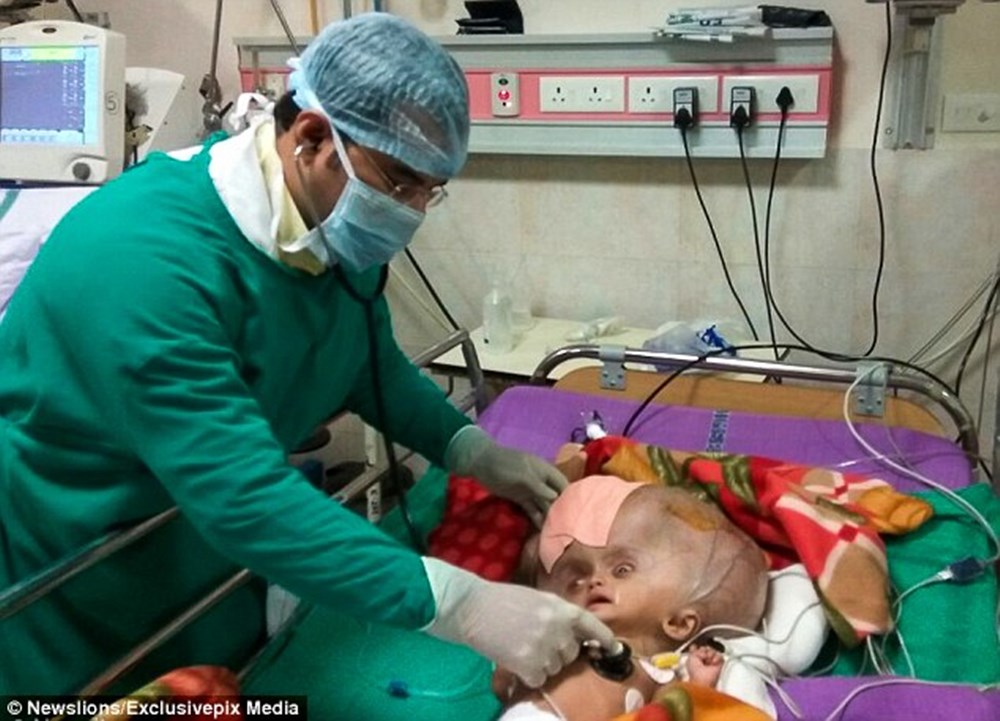 水頭症の少年を救え！ 世界最大の頭を持つインドの少年