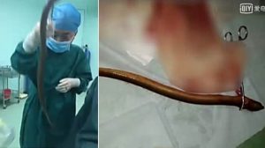 【本人は便秘解消のためと主張】中国の49歳男性、お尻にウナギを挿入し手術へ